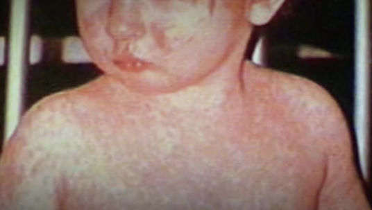 measles in canada